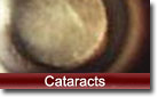 Cataracts