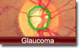 Glaucoma