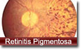Retinitis Pigmentosa