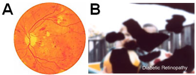 Progressing stages of retinitis pigmentosa