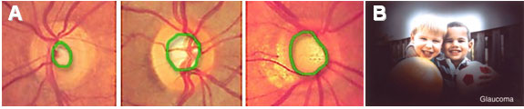 Progressing stages of retinitis pigmentosa