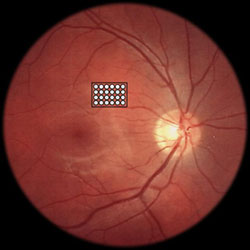 Schematic showing the position of the stimulating array on the retina of the eye
