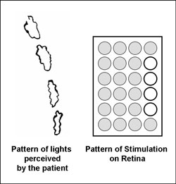 Example of patterns of light reported by patients after using the prosthesis