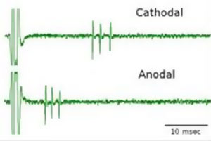 Responses of a retinal ganglion cell to cathodal and anodal stimuli applied through a subretinal stimulating electrode. Note that in both cases a response was generated but the timing of the response differed.