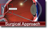 Surgical Approach