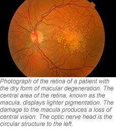 dry macular degeneration