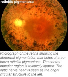 retinitis pigmentosa